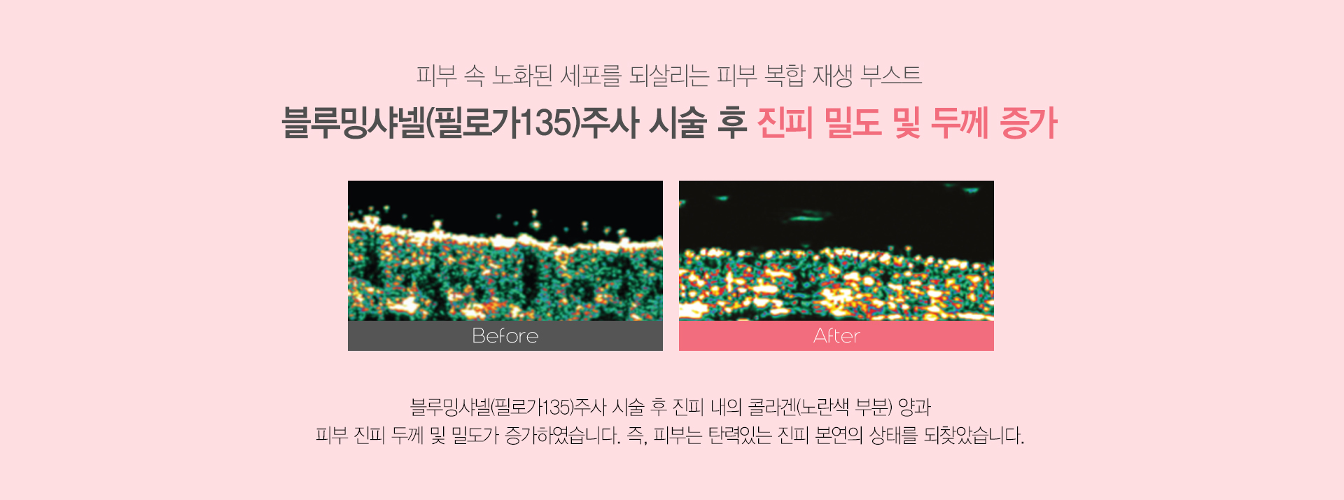 피부 속 노화된 세포를 되살리는 피부 복합 재생 부스트 블루밍 샤넬 주사 시술 후 진피 밀도 및 두께 증가 블루밍샤넬 주사 시술 후 진피 내의 콜라겐 양과 피부 진피 두께 및 밀도가 증가하였습니다. 즉 피부는 탄력있는 진피 본연의 상태를 되찾았습니다.
