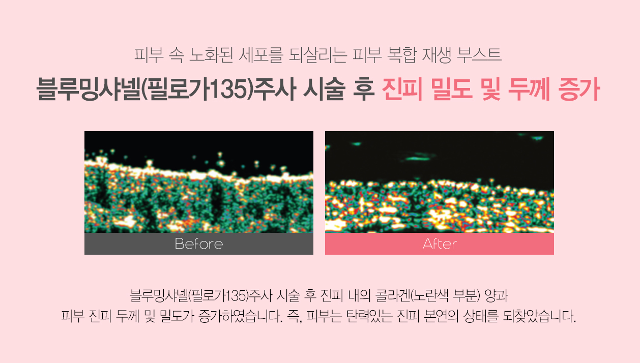 피부 속 노화된 세포를 되살리는 피부 복합 재생 부스트 블루밍 샤넬 주사 시술 후 진피 밀도 및 두께 증가 블루밍샤넬 주사 시술 후 진피 내의 콜라겐 양과 피부 진피 두께 및 밀도가 증가하였습니다. 즉 피부는 탄력있는 진피 본연의 상태를 되찾았습니다.
